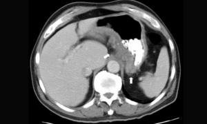 CT scan of patient shown en:Crohn's disease in the fundus of the en:stomach. Released into public domain on permission of patient -- Samir धर्म 10:27, 3 June 2006 (UTC)- wikipedia